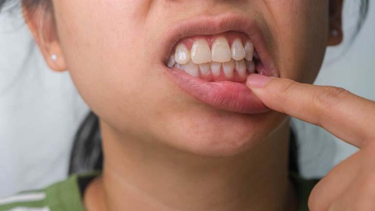 Sigara, diş eti sağlığını olumsuz etkiliyor! Sigarayı bırakmak için ipuçları