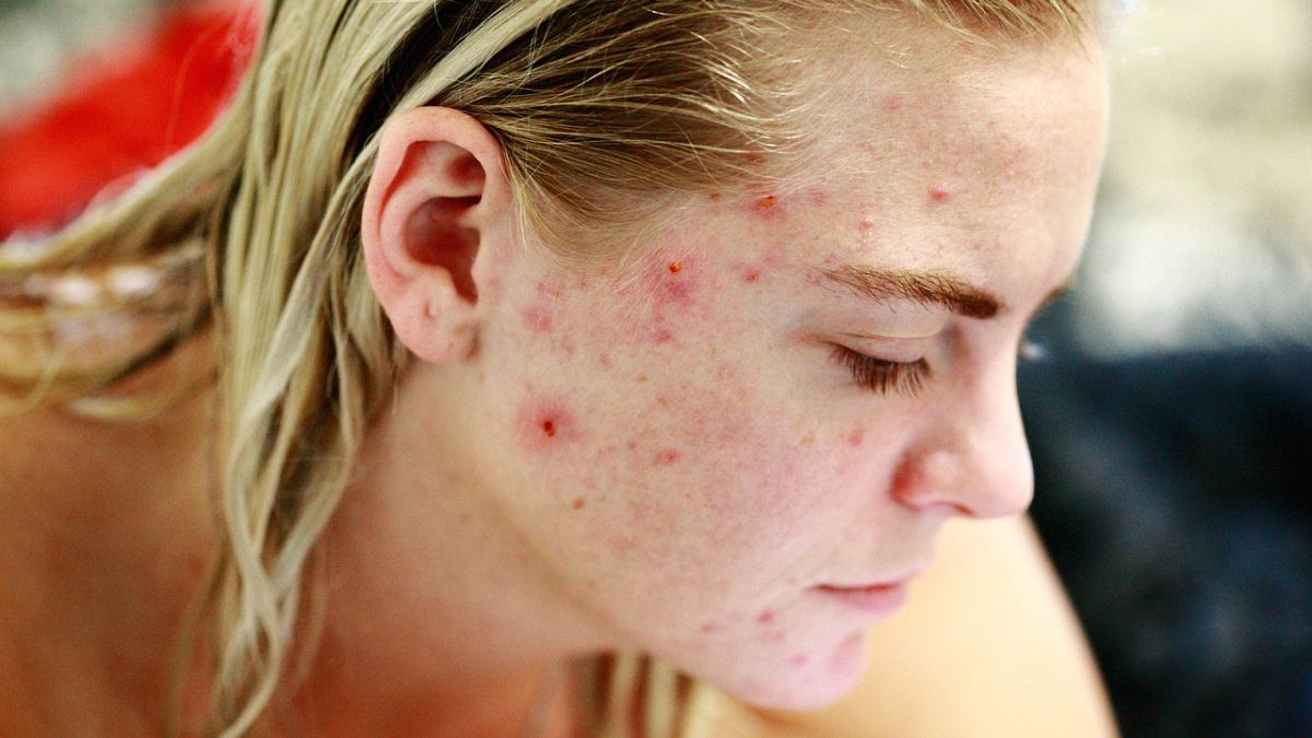 Sivilce için mRNA aşısı geliştirildi: Klinik deneyler devam ediyor